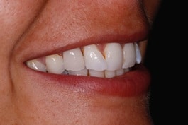 Dental Bonding, denture changed to a bridge after