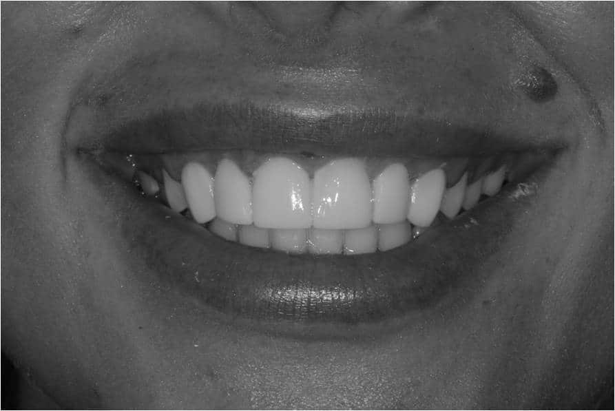What is Dental Bonding? Thumbnail