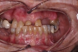 Dental Bonding veneers before and after