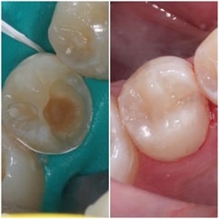 Dental Bonding, White filling before and after