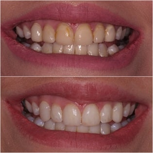 Badly worn teeth after dental bonding