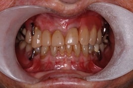 Badly worn teeth before dental bonding