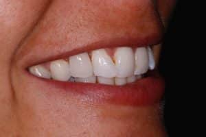 After Dental Bridges from Carillon