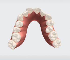 Smile simulation before