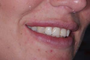 Dental Veneers -before