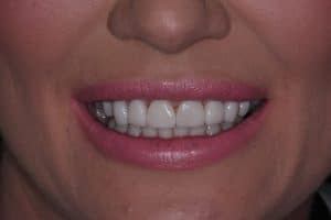 Dental Veneers -after