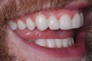 Enlighten Teeth Whitening After