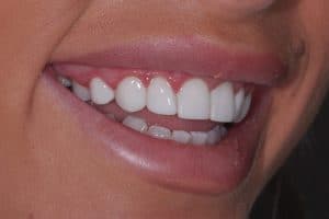 Composite dental bonding - after