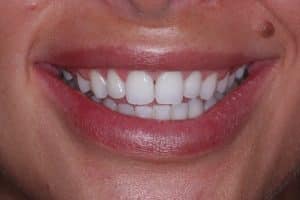 Composite dental bonding- before