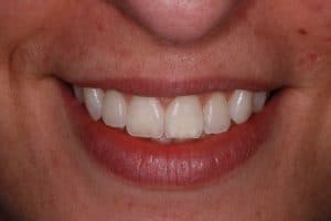 PolaDay Teeth Whitening After