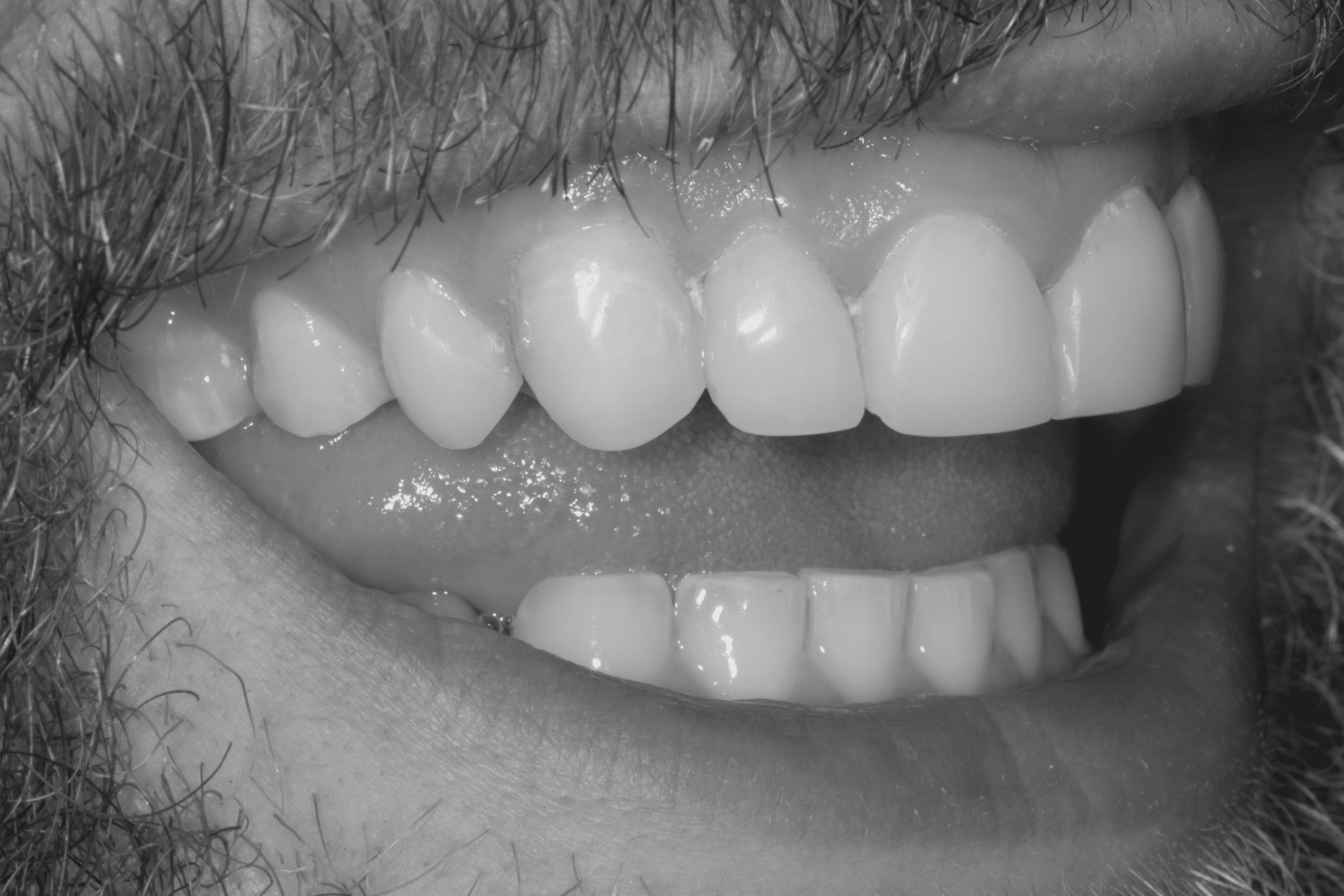 Tooth Sensitivity Treatment and Causes Thumbnail