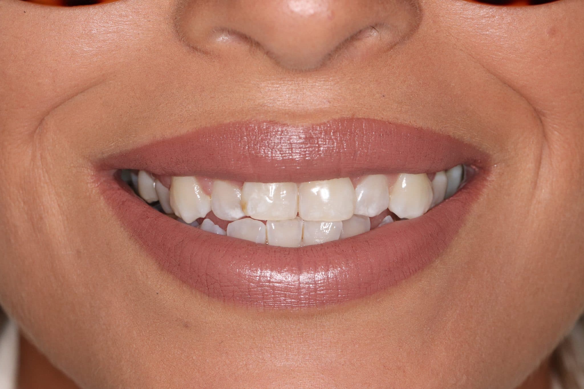 Quick Straight Teeth (Adult Braces) in Loughborough ... Quick Straight Teeth (Adult Braces) in Loughborough ...